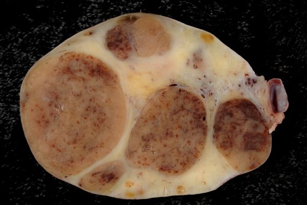 Luteoma of Pregnancy, Oophorectomy (gross)